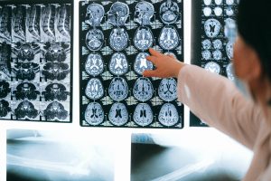 Levels of Traumatic Brain Injuries from Delaware Car Accidents