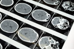 Are There Delaware Disability Benefits for Brain Injuries?